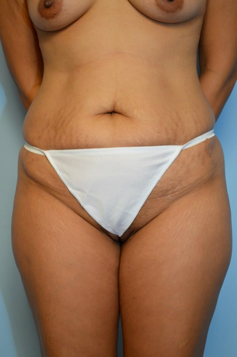 Liposuction Before & After Gallery - Patient 287603 - Image 1