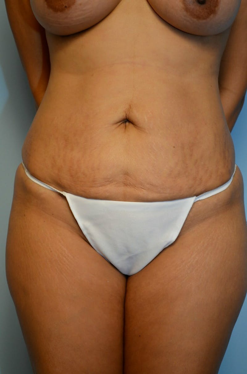 Liposuction Before & After Gallery - Patient 287603 - Image 2