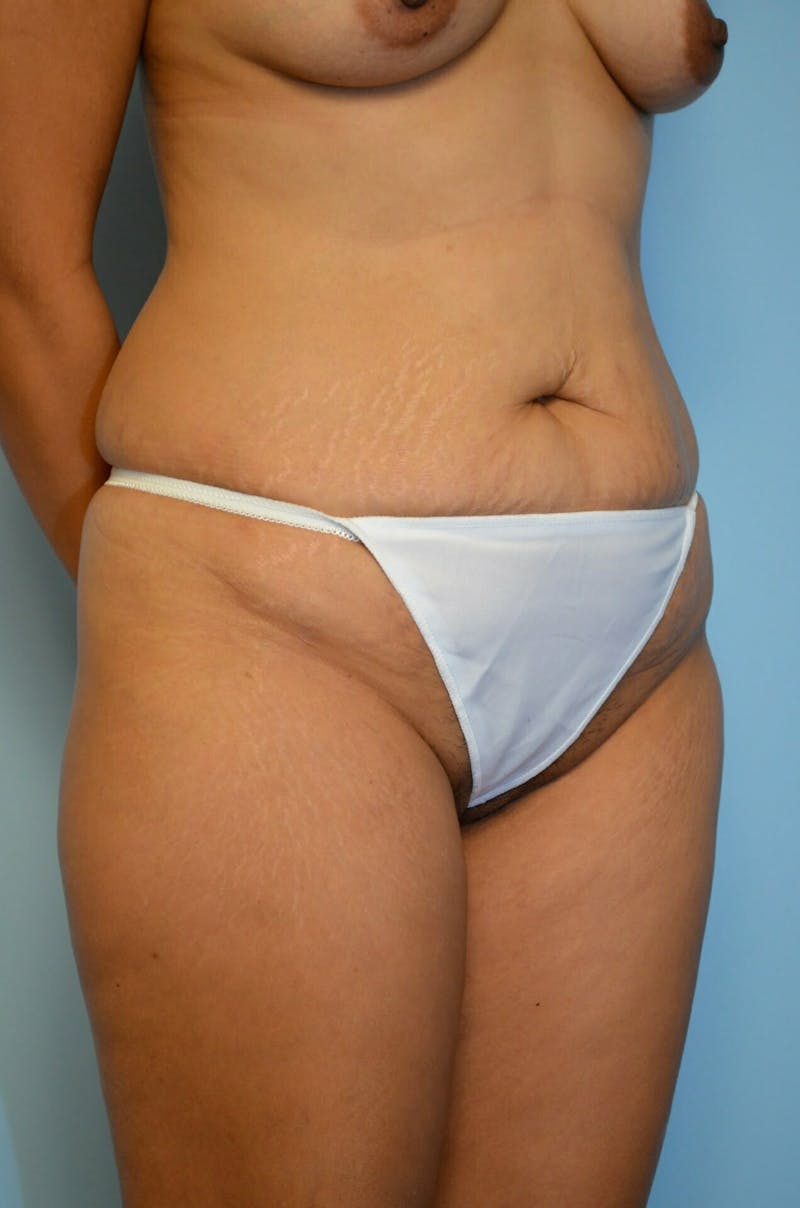 Liposuction Before & After Gallery - Patient 287603 - Image 3