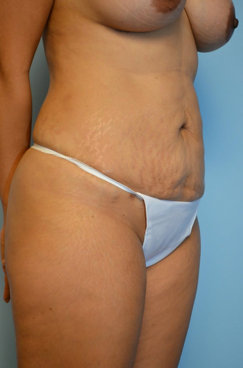 Liposuction Before & After Gallery - Patient 287603 - Image 4