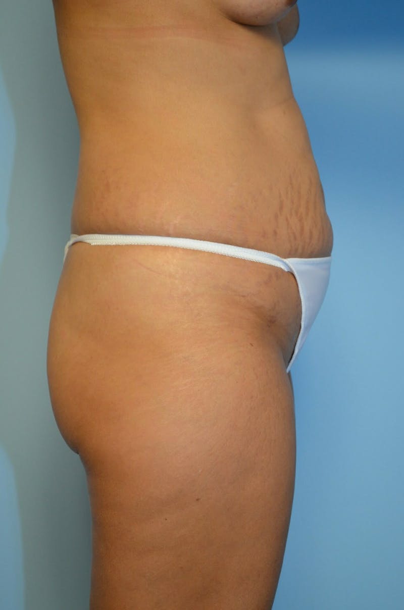 Liposuction Before & After Gallery - Patient 287603 - Image 5
