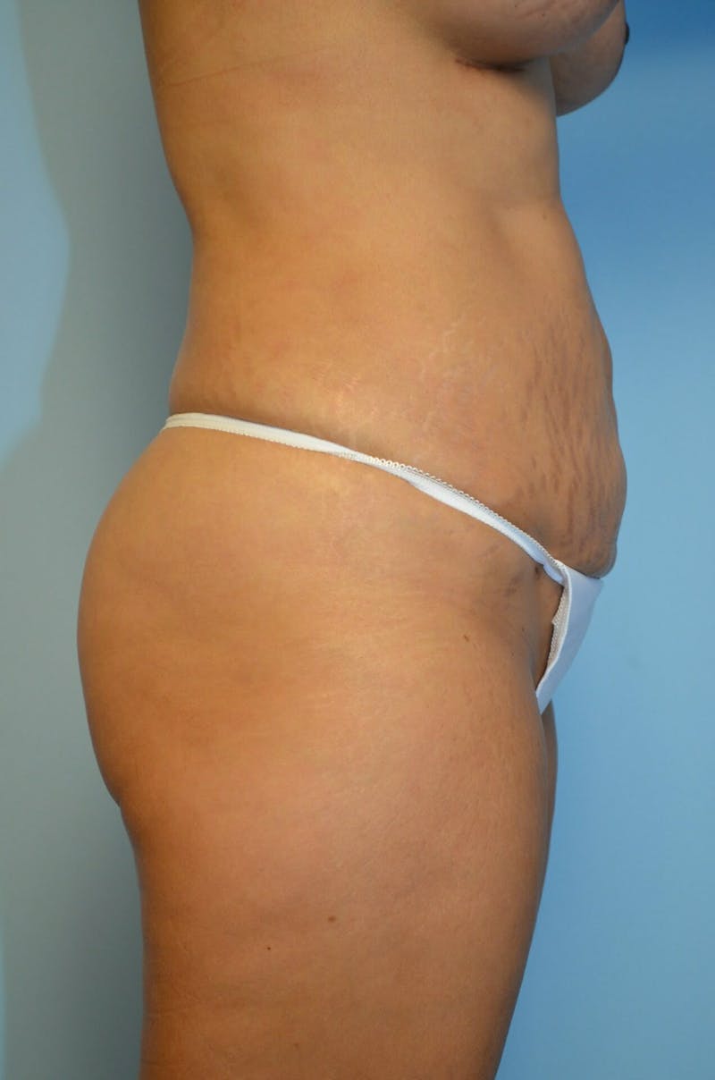 Liposuction Before & After Gallery - Patient 287603 - Image 6