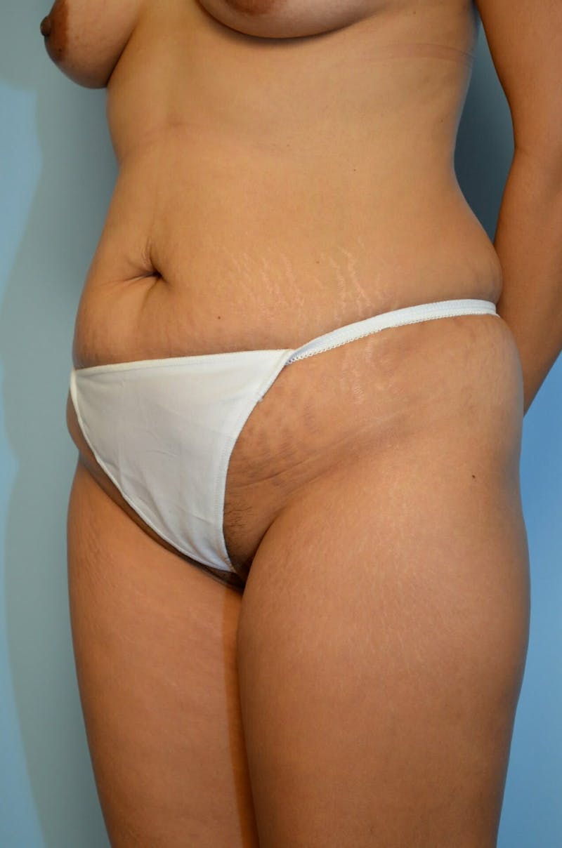 Liposuction Before & After Gallery - Patient 287603 - Image 7