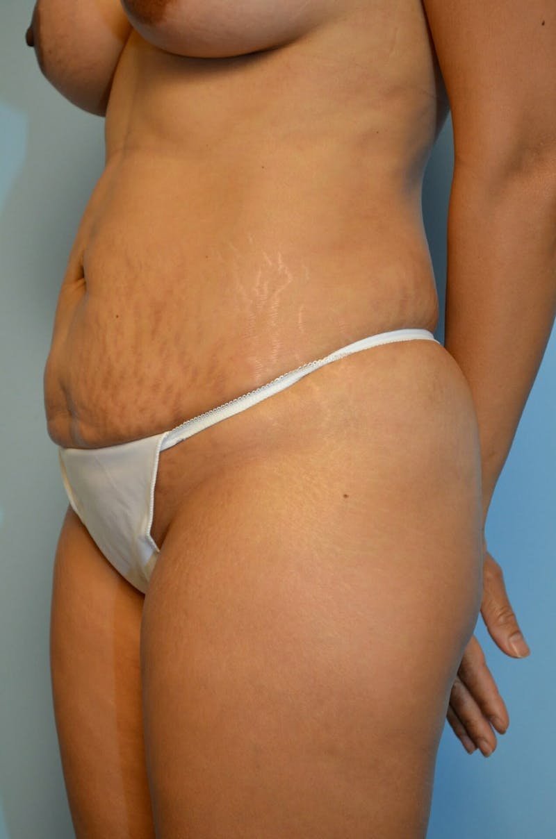 Liposuction Before & After Gallery - Patient 287603 - Image 8