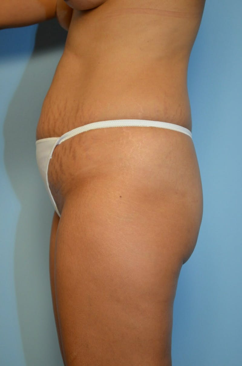 Liposuction Before & After Gallery - Patient 287603 - Image 9