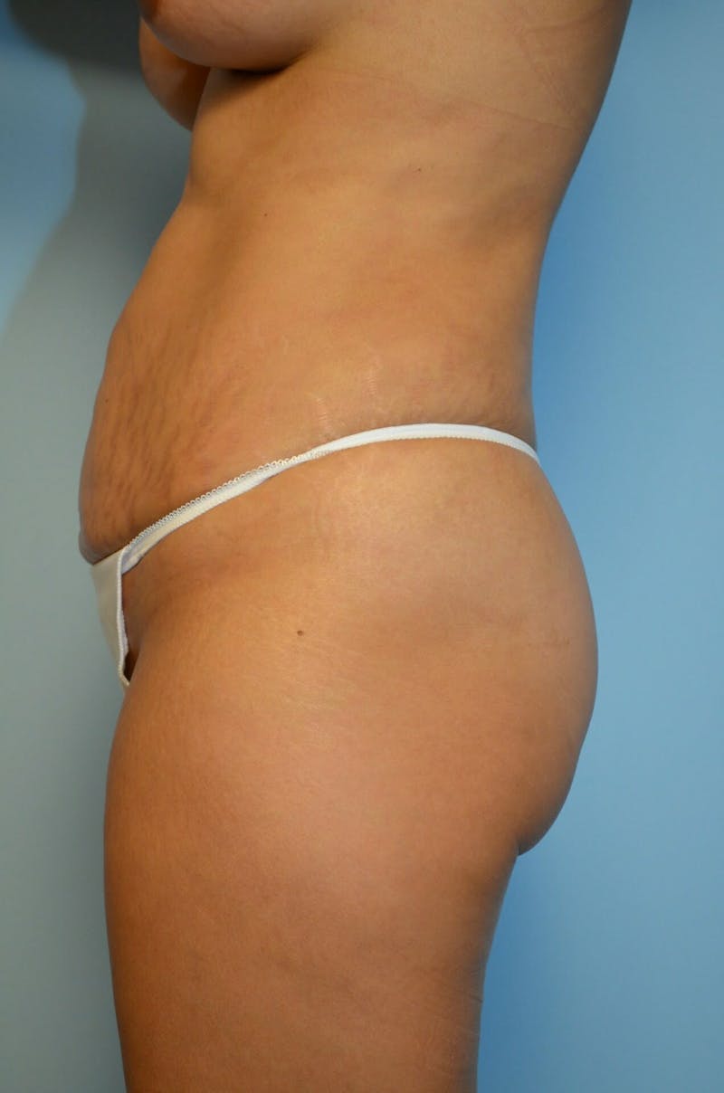 Liposuction Before & After Gallery - Patient 287603 - Image 10