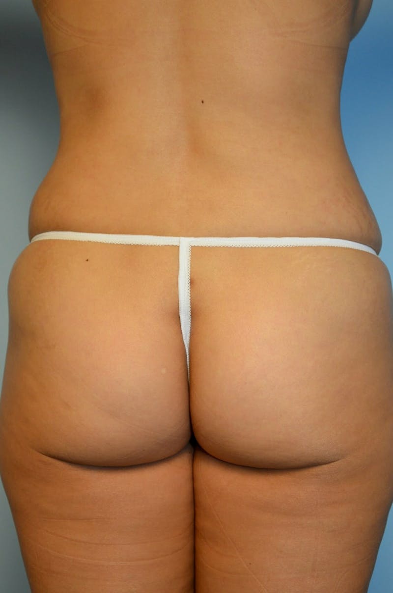 Liposuction Before & After Gallery - Patient 287603 - Image 11