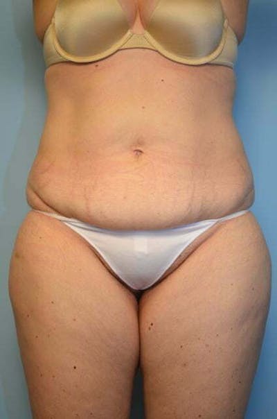 Body Contouring Before & After Gallery - Patient 392925 - Image 1