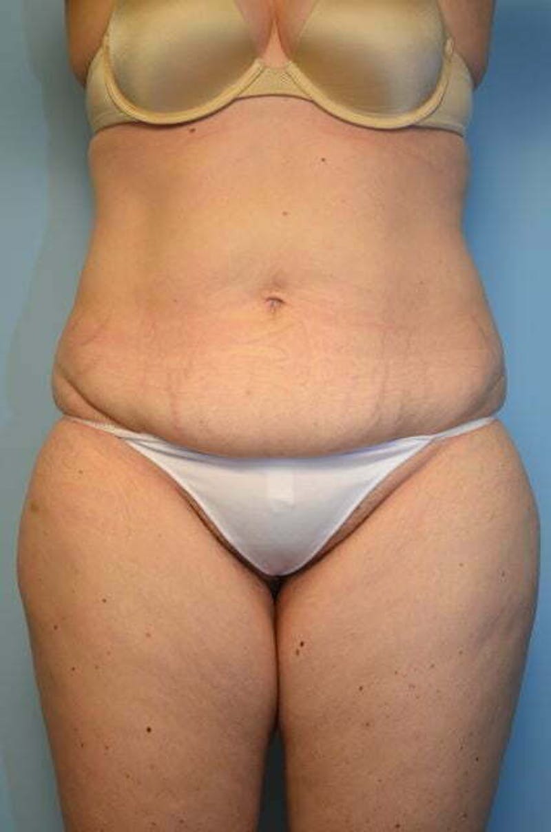 Liposuction Before & After Gallery - Patient 206794 - Image 1