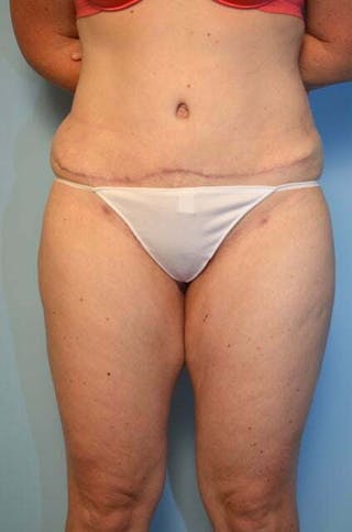Liposuction Before & After Gallery - Patient 206794 - Image 2