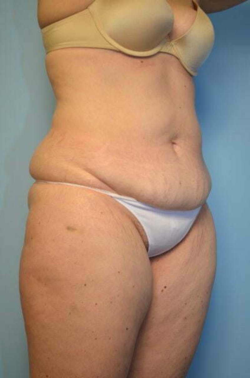 Liposuction Before & After Gallery - Patient 206794 - Image 3