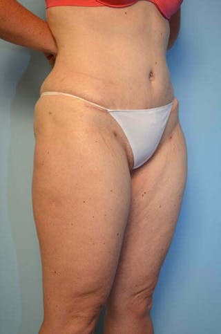 Liposuction Before & After Gallery - Patient 206794 - Image 4