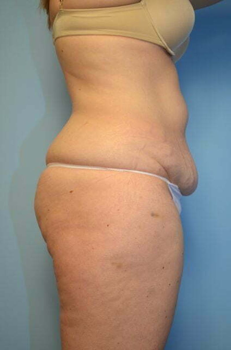 Liposuction Before & After Gallery - Patient 206794 - Image 5