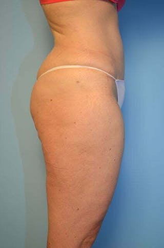 Liposuction Before & After Gallery - Patient 206794 - Image 6