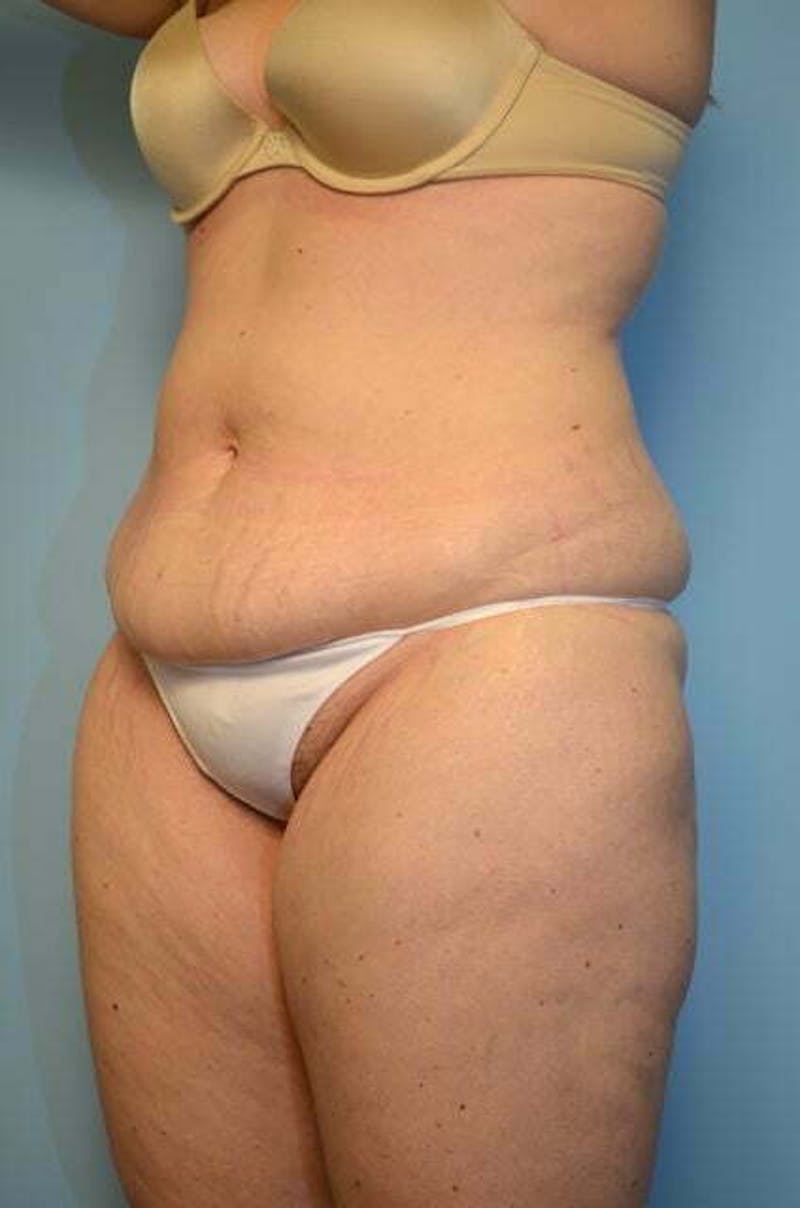 Liposuction Before & After Gallery - Patient 206794 - Image 7