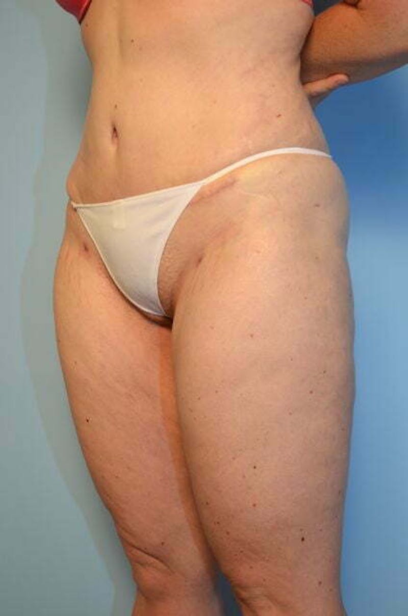 Liposuction Before & After Gallery - Patient 206794 - Image 8