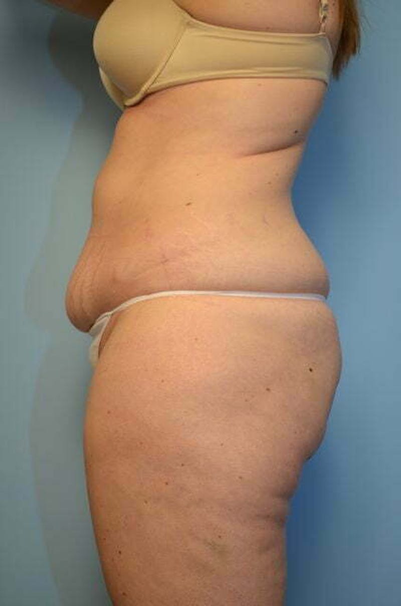 Liposuction Before & After Gallery - Patient 206794 - Image 9