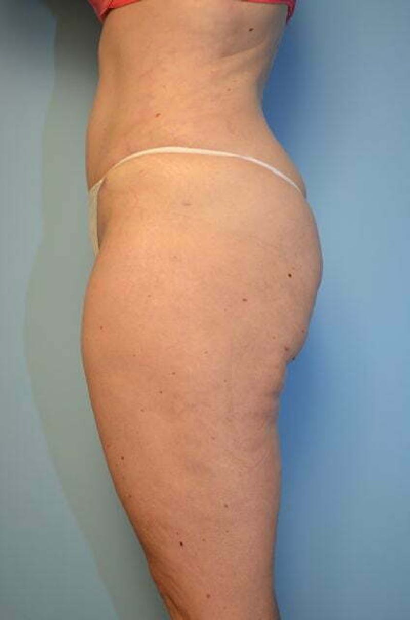 Liposuction Before & After Gallery - Patient 206794 - Image 10