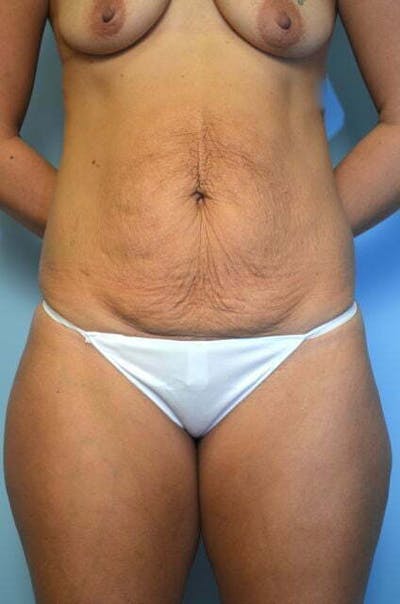 Body Contouring Before & After Gallery - Patient 234343 - Image 1