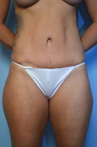 Tummy Tuck Before & After Gallery - Patient 164475 - Image 2