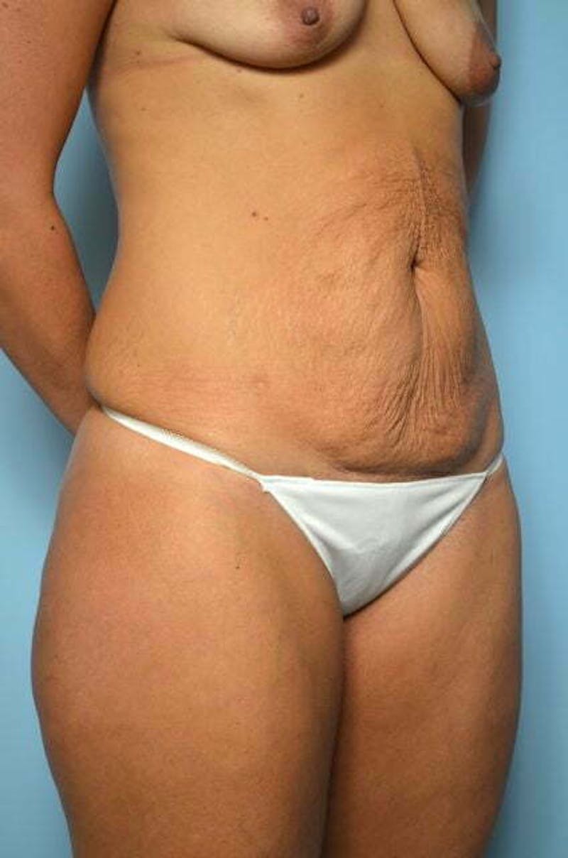 Tummy Tuck Before & After Gallery - Patient 164475 - Image 3