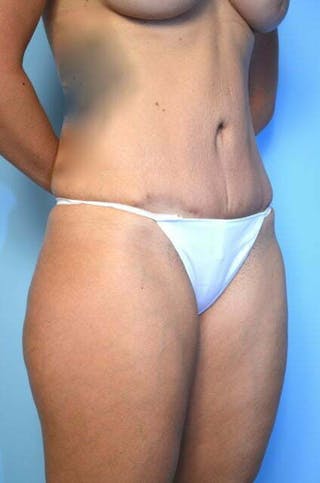 Tummy Tuck Before & After Gallery - Patient 164475 - Image 4