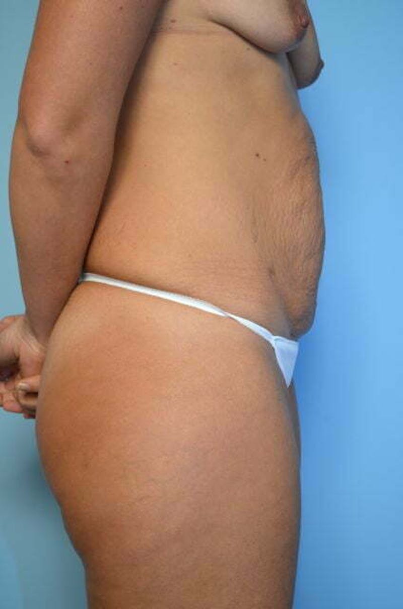 Tummy Tuck Before & After Gallery - Patient 164475 - Image 5