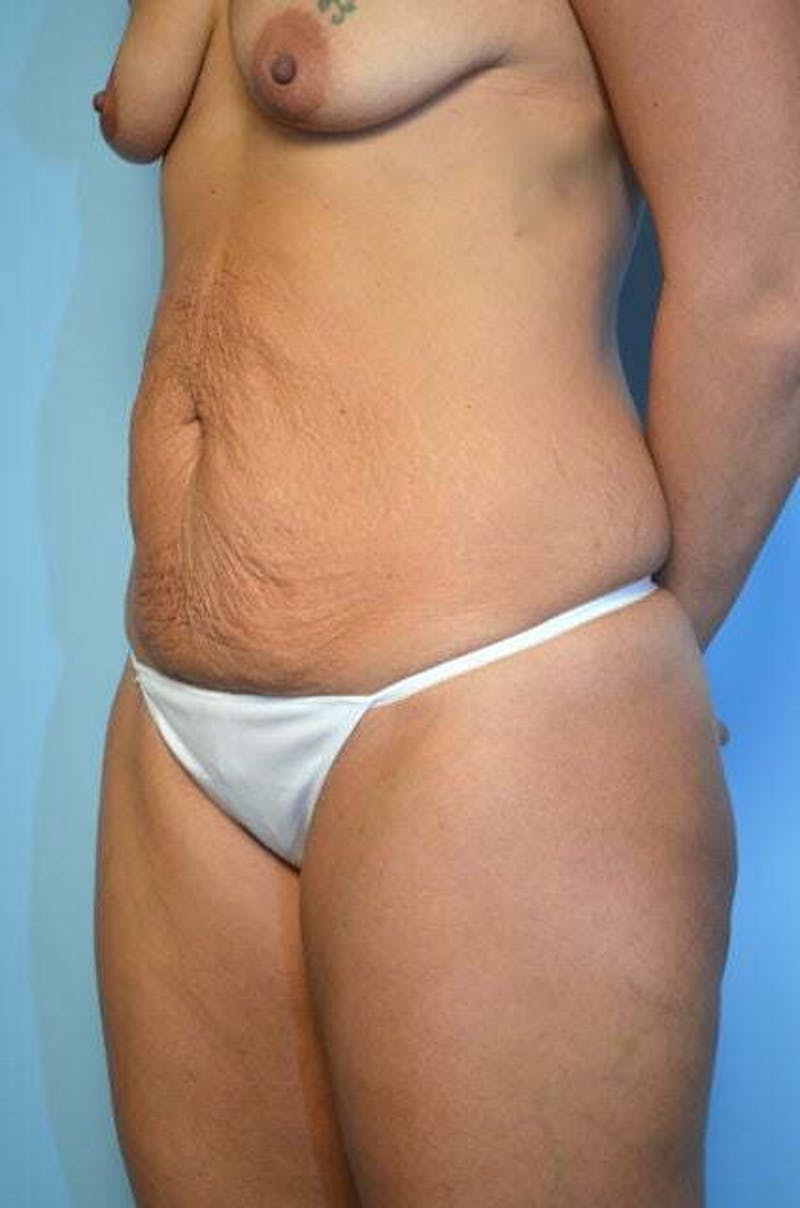 Tummy Tuck Before & After Gallery - Patient 164475 - Image 7
