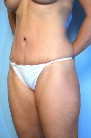 Tummy Tuck Before & After Gallery - Patient 164475 - Image 8