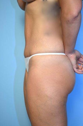 Tummy Tuck Before & After Gallery - Patient 164475 - Image 10