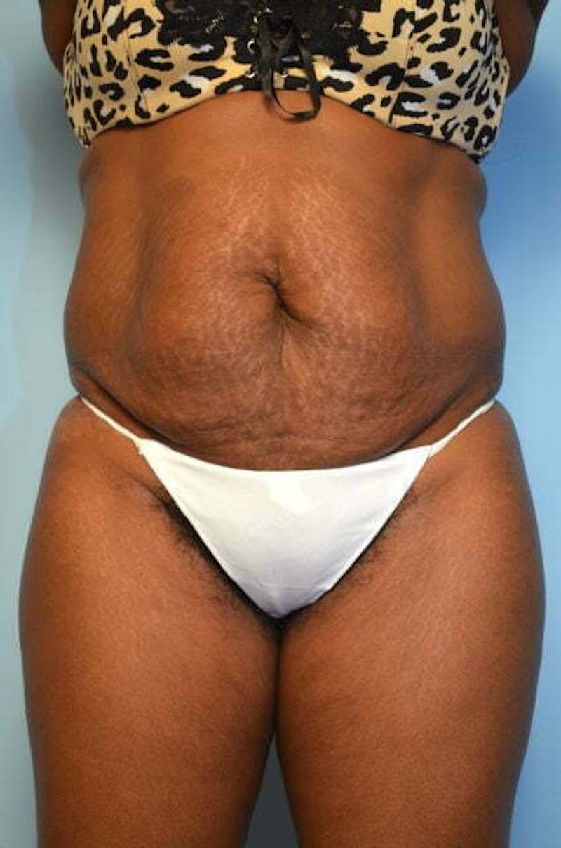 Liposuction Before & After Gallery - Patient 128479 - Image 1