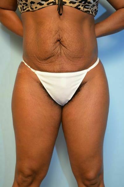 Body Contouring Before & After Gallery - Patient 123392 - Image 2