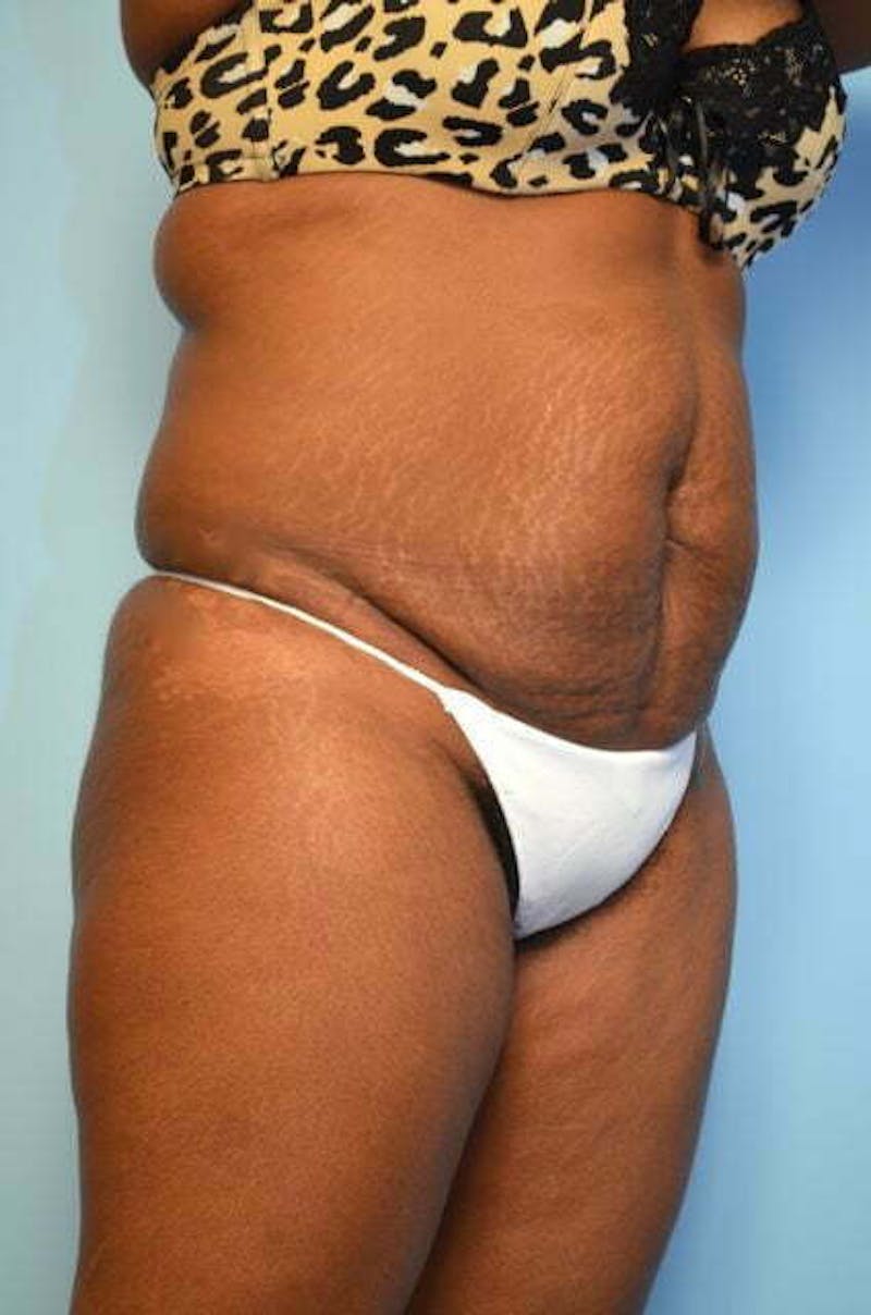 Liposuction Before & After Gallery - Patient 128479 - Image 3