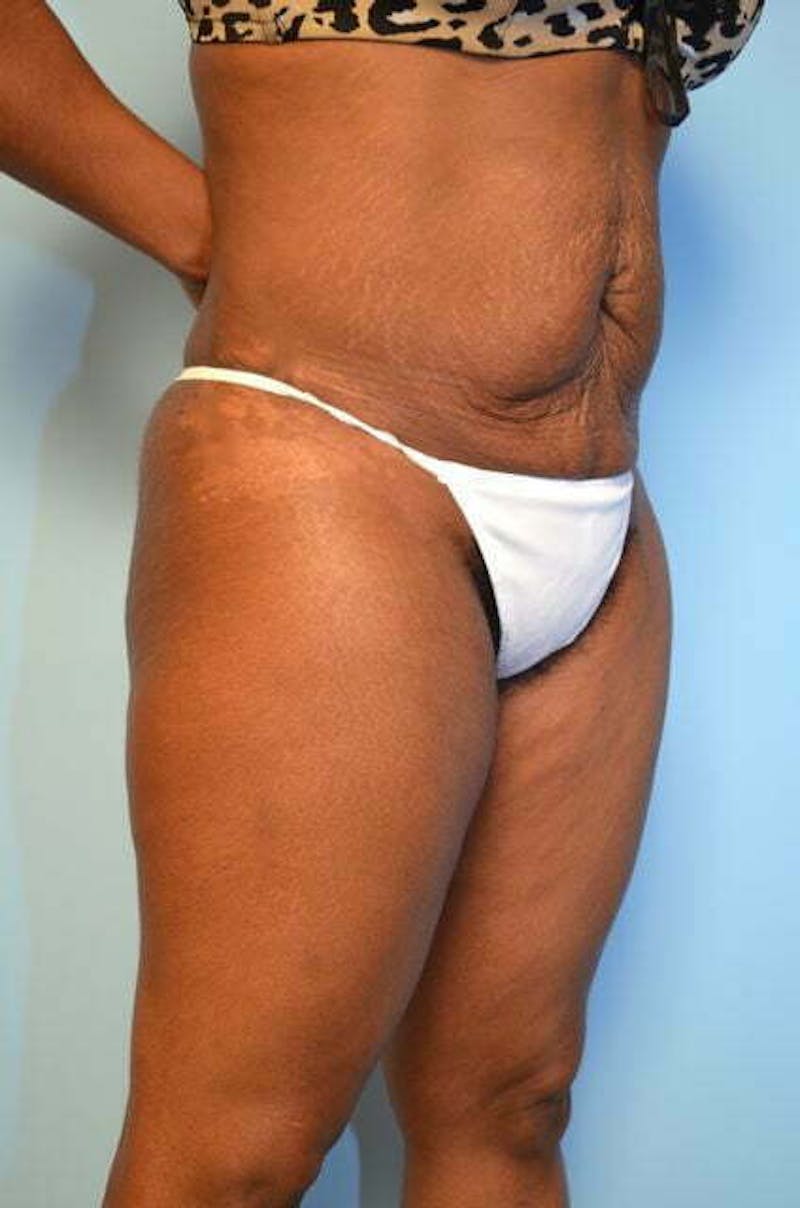 Liposuction Before & After Gallery - Patient 128479 - Image 4