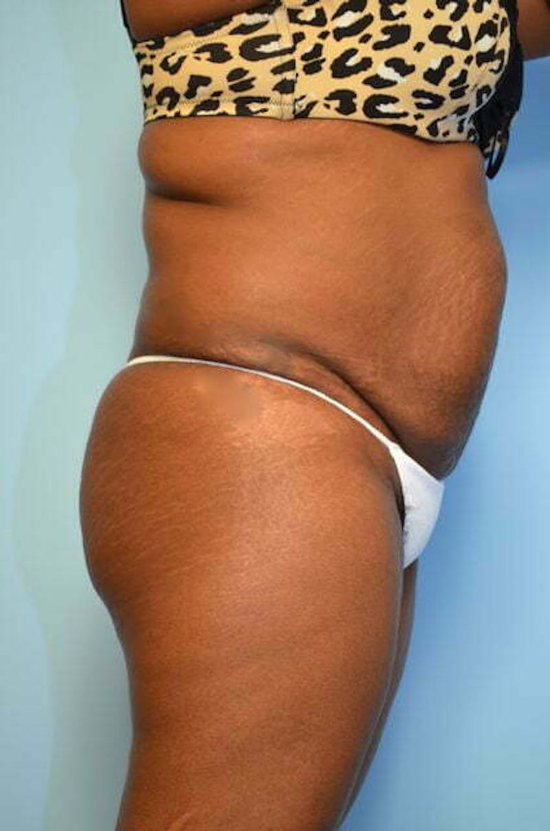 Liposuction Before & After Gallery - Patient 128479 - Image 5