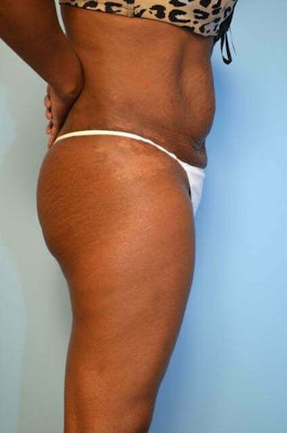 Liposuction Before & After Gallery - Patient 128479 - Image 6