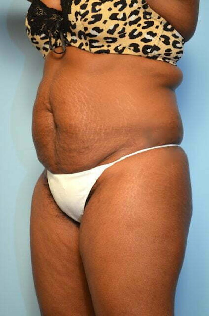 Liposuction Before & After Gallery - Patient 128479 - Image 7