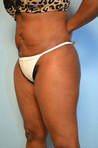 Liposuction Before & After Gallery - Patient 128479 - Image 8