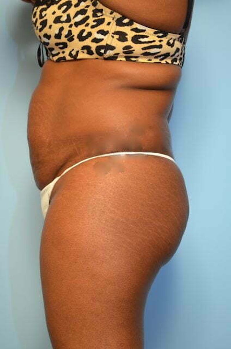 Liposuction Before & After Gallery - Patient 128479 - Image 9