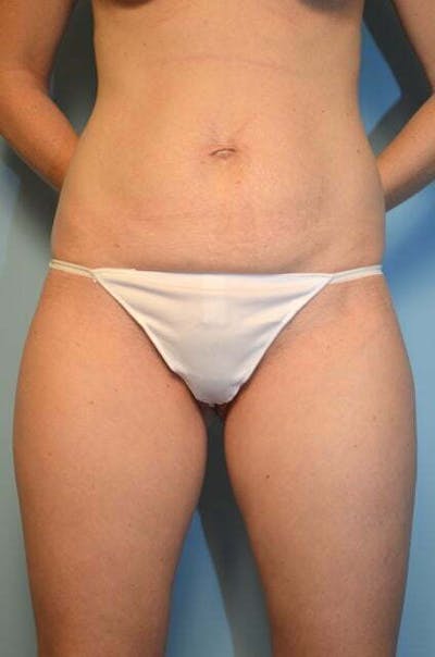Body Contouring Before & After Gallery - Patient 367570 - Image 1