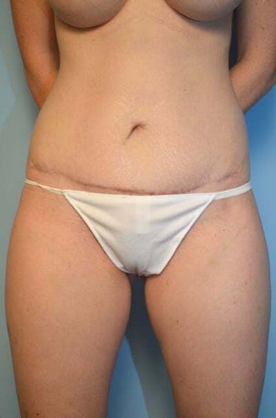 Body Contouring Before & After Gallery - Patient 367570 - Image 2