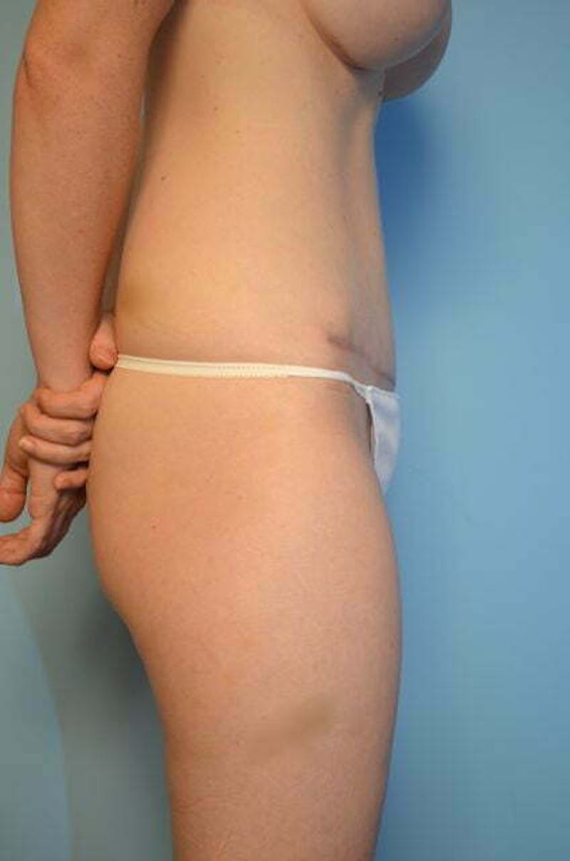 Umbilical Float Tummy Tuck Before & After Gallery - Patient 487466 - Image 6