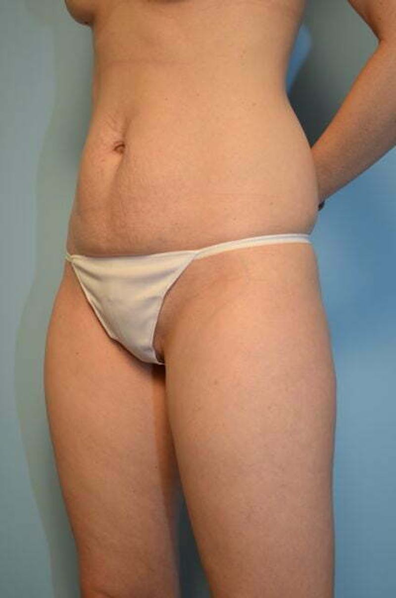 Umbilical Float Tummy Tuck Before & After Gallery - Patient 487466 - Image 7