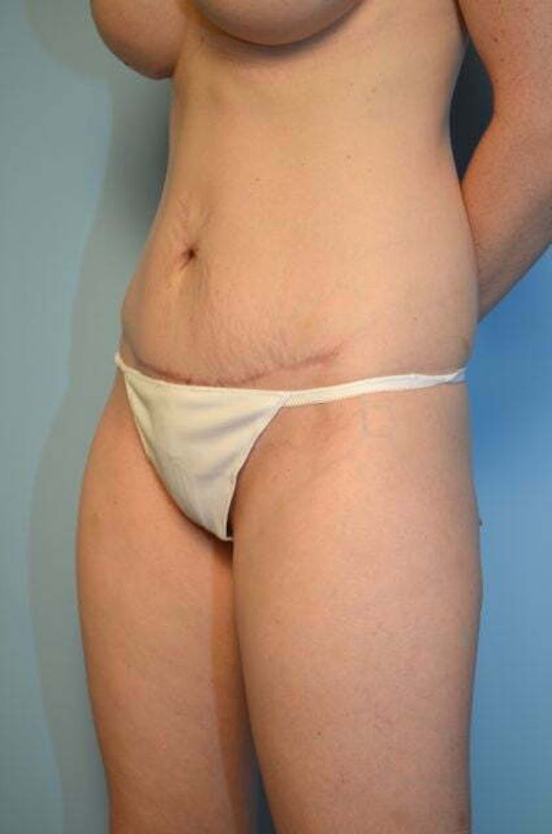 Umbilical Float Tummy Tuck Before & After Gallery - Patient 487466 - Image 8