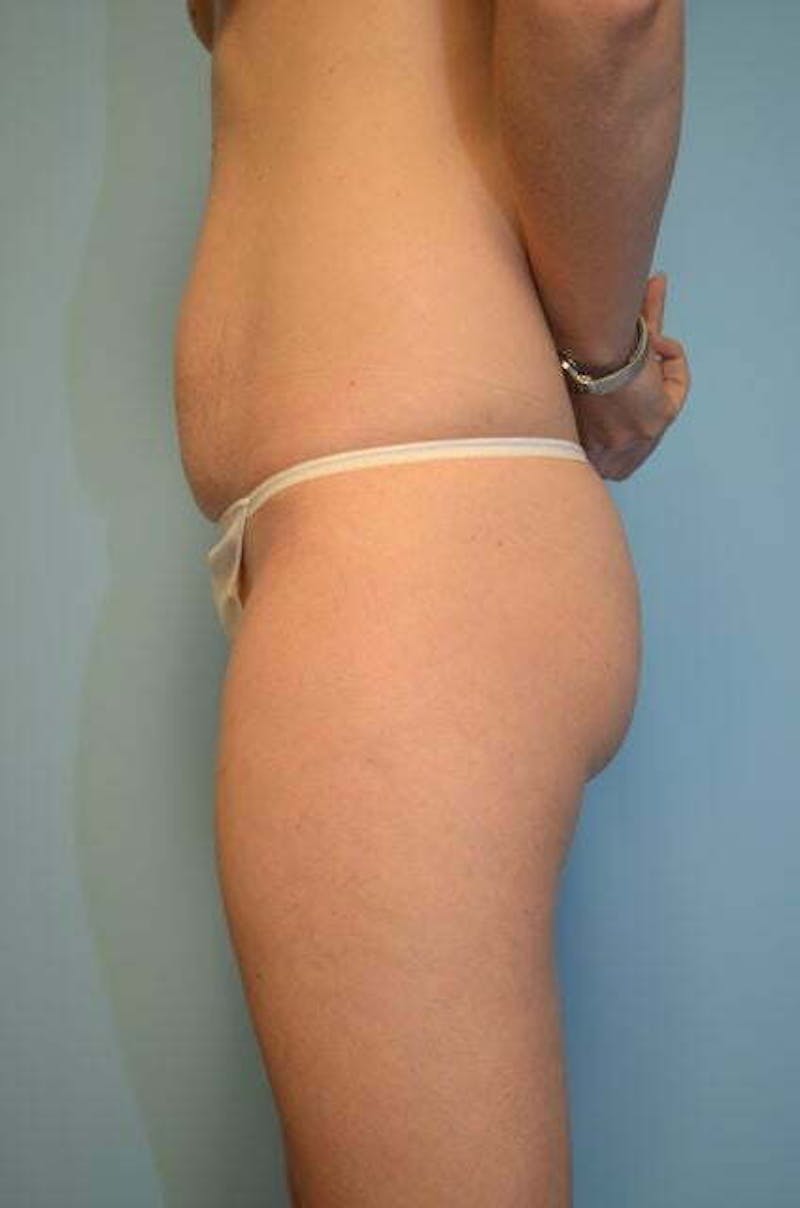 Umbilical Float Tummy Tuck Before & After Gallery - Patient 487466 - Image 9
