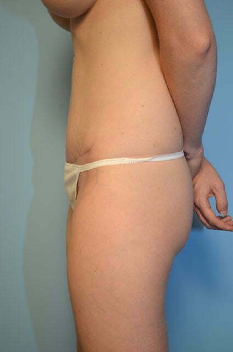 Umbilical Float Tummy Tuck Before & After Gallery - Patient 487466 - Image 10