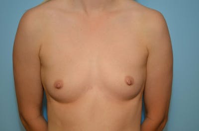 Breast Other Before & After Gallery - Patient 355725 - Image 1