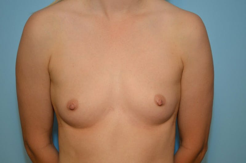 Breast Other Before & After Gallery - Patient 355725 - Image 1