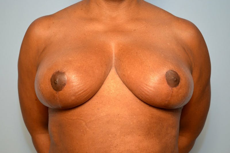 Breast Reduction Before & After Gallery - Patient 397284 - Image 2