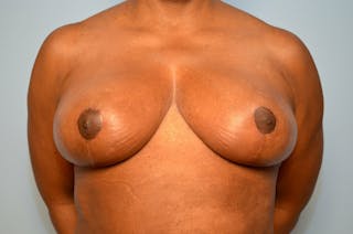 Breast Reduction Before & After Gallery - Patient 397284 - Image 2